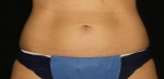 Coolsculpting to Abdomen After